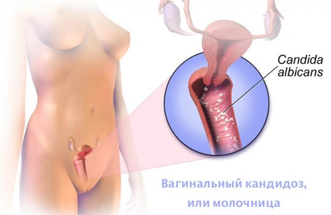Симптомы молочницы у женщин