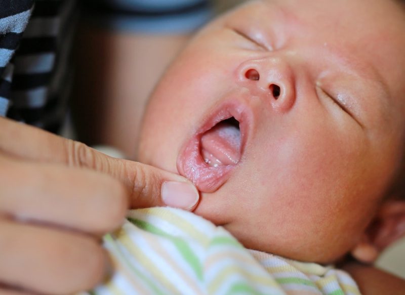 Лечение белого налета на языке у ребенка