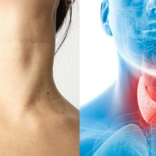 Причины роста и классификация зоба щитовидной железы