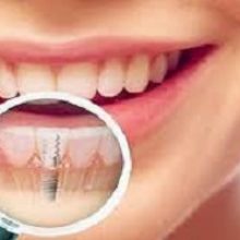 Нюансы имплантации зубов