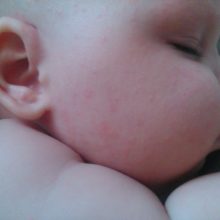 Причины потницы у новорожденных и как с ней справиться